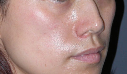 cheek implants surgery before photo patient